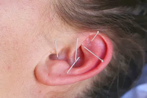 Middle Path Acupuncture - Acupuncture Clinic in San Francisco, CA 5