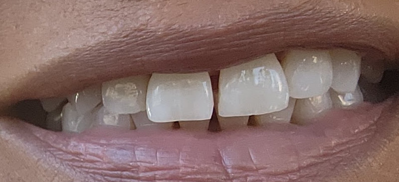 Alameda Aesthetic Dentistry - Dr. Piyush Sisodia DDS MPH 2