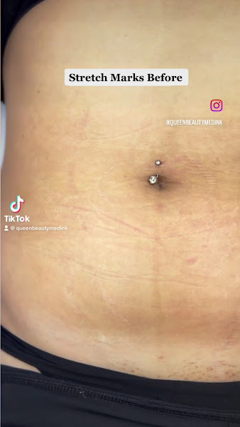 Queen Beauty Medink 2