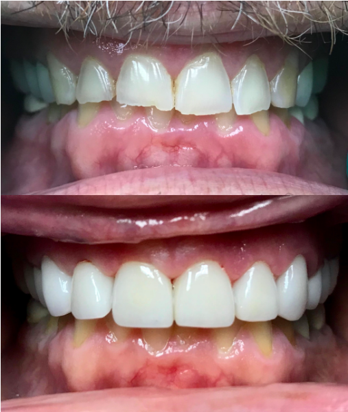 HDentaL 3