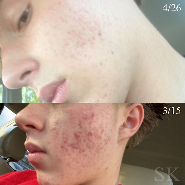 Skin Klarity 3