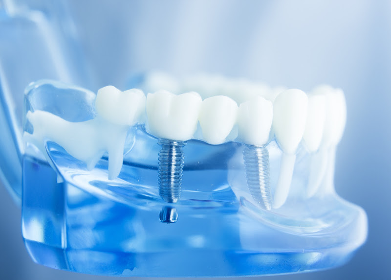 Santee Dental Care 4