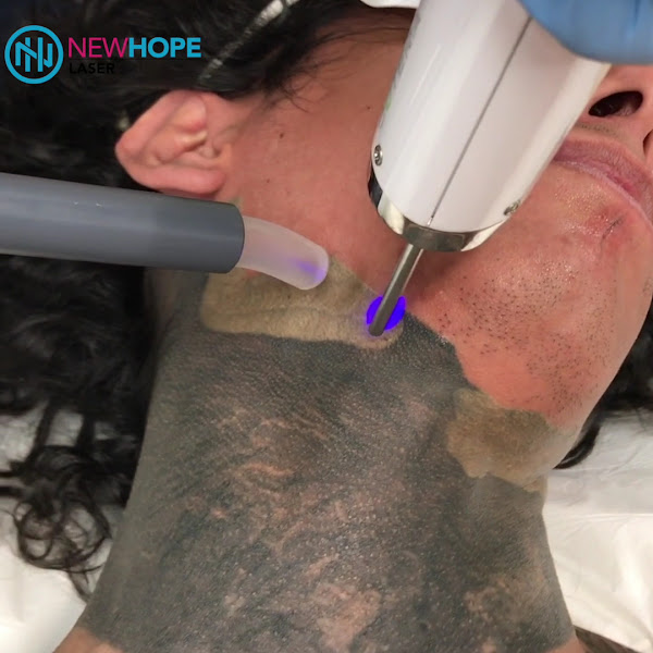 Newhope Laser Skin Care 2