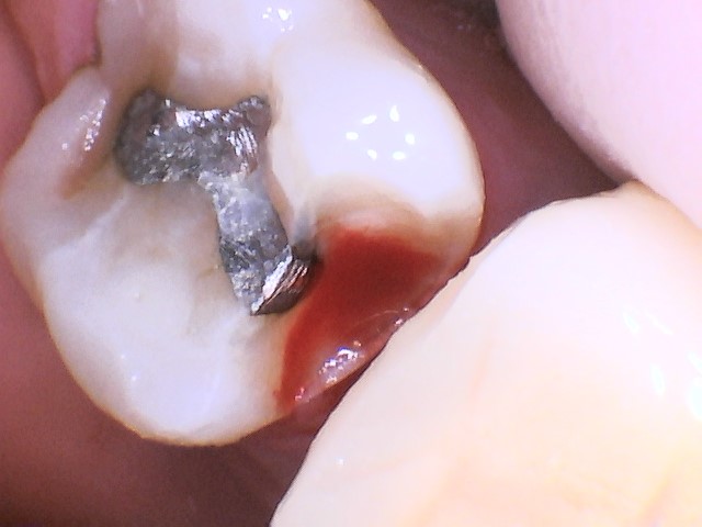 Glow Dental Orange 3